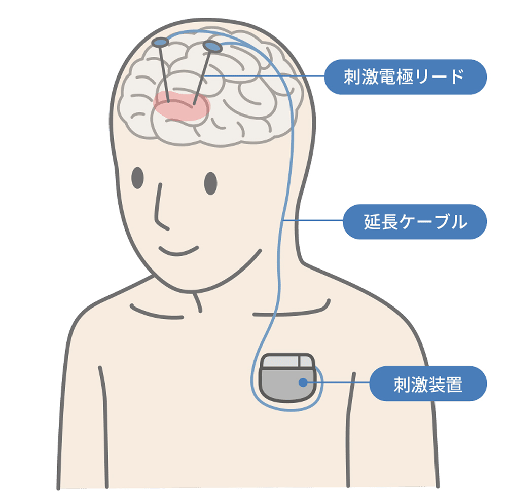 脳深部刺激療法