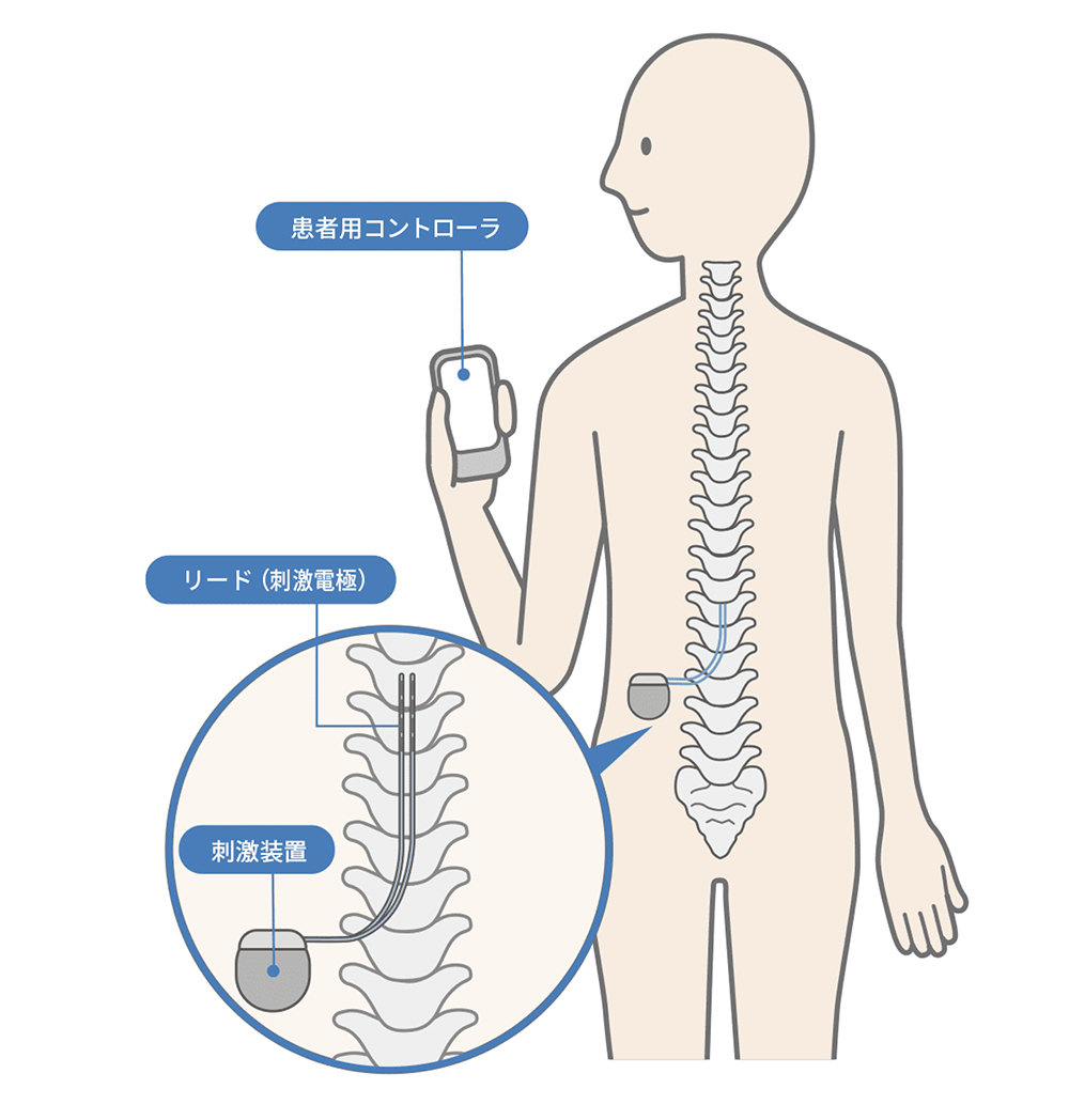 髄電気刺激療法