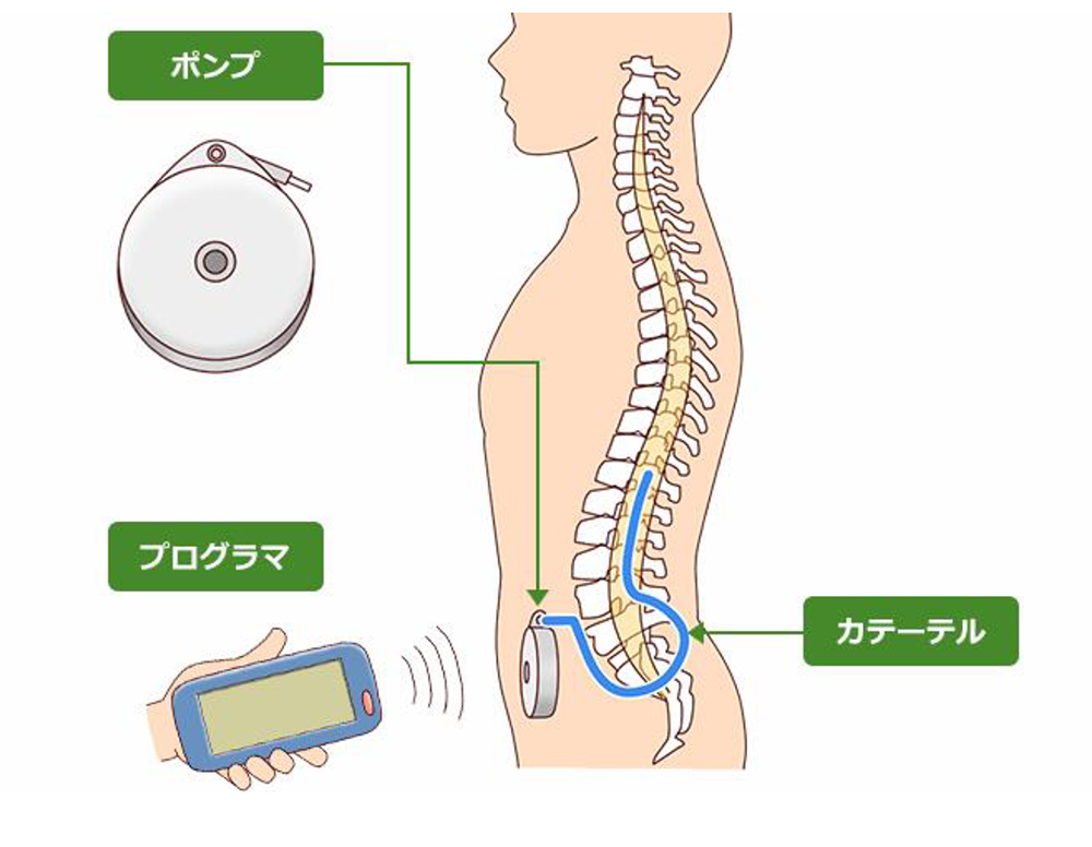 バクロフェン髄腔内投与療法